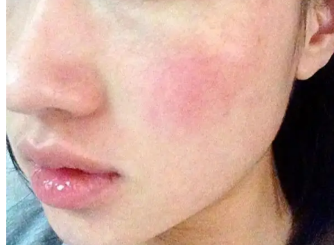 兰州华医皮肤病 大腿内侧很多疙瘩又疼又痒是过敏性皮炎吗