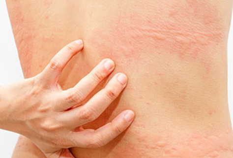 兰州华医皮肤病医院 哪些因素会引发花斑糠疹