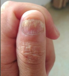 兰州华医皮肤病医院 灰指甲有哪些有效的治疗方法