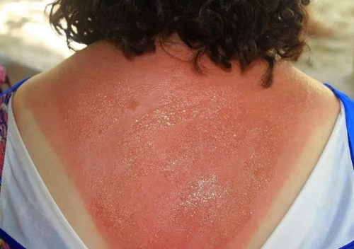 兰州华医皮肤病 晒太阳会加重头皮炎症吗